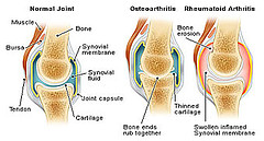 osteoarthritis_rheumatoid_arthritis_by_ilovepiano.jpg